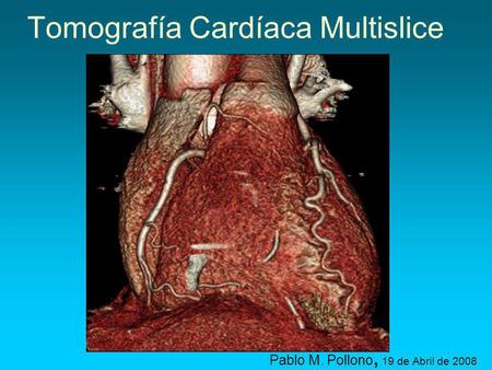 Tomografía Cardíaca Multislice