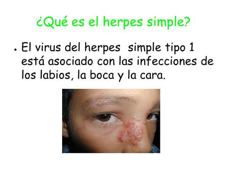 ¿Qué es el herpes simple?
