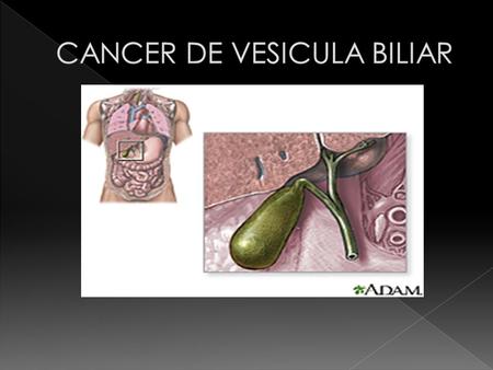 CANCER DE VESICULA BILIAR
