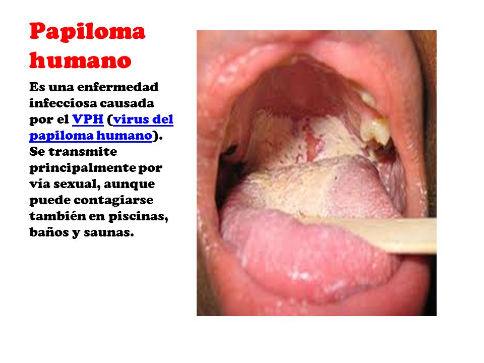 Enfermedades venereas papiloma humano fotos Enfermedades venereas papiloma humano fotos