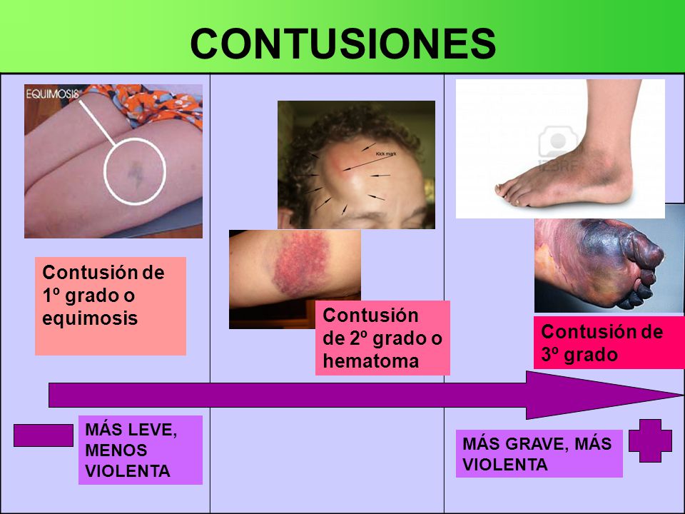 What is contusion What is contusion