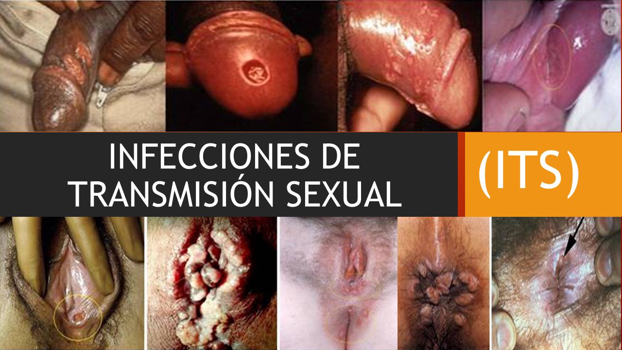 Infecciones Sexsuales 5