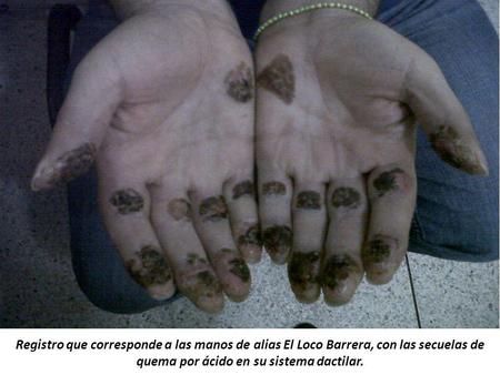 Registro que corresponde a las manos de alias El Loco Barrera, con las secuelas de quema por ácido en su sistema dactilar.