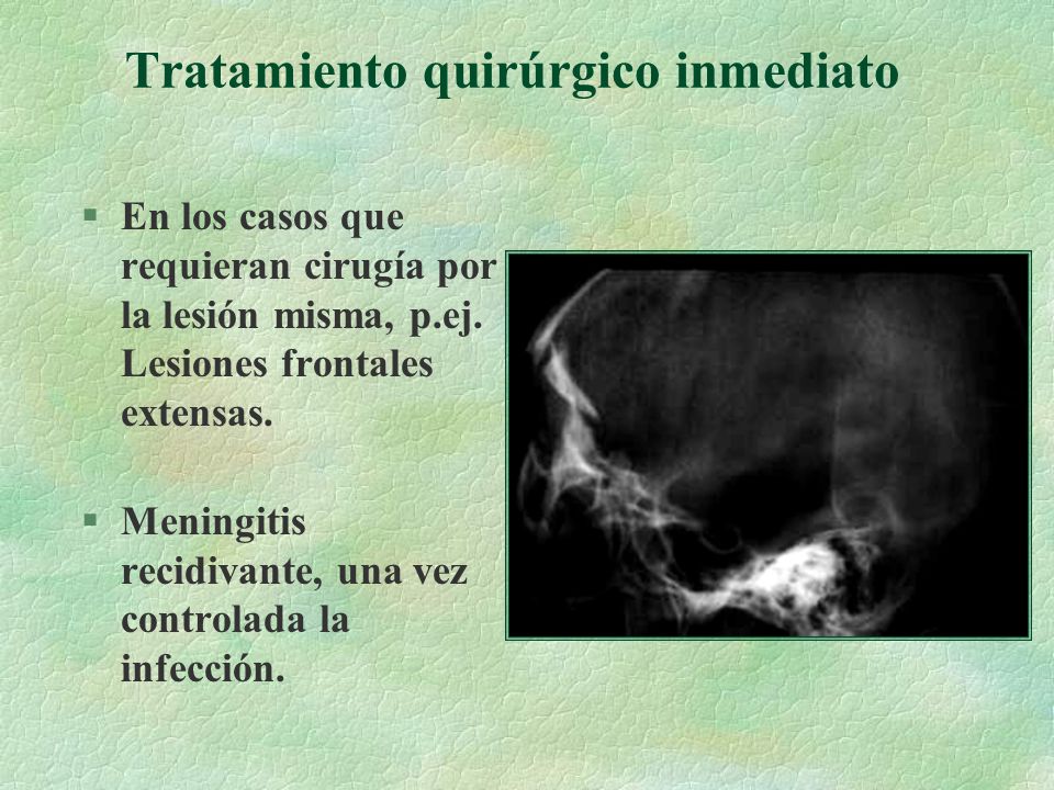 Fistulas Craneales de Lìquido Cefalorraquídeo - ppt descargar Fistulas Craneales de Lìquido Cefalorraquídeo - ppt descargar