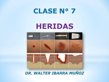 CLASE N° 7 HERIDAS DR. WALTER IBARRA MUÑOZ. DEFINICIÓN  Es la pérdida de la continuidad EN LAS PARTES BLANDAS DEL CUERPO COMO CONSECUENCIA DE UN TRAUMA.