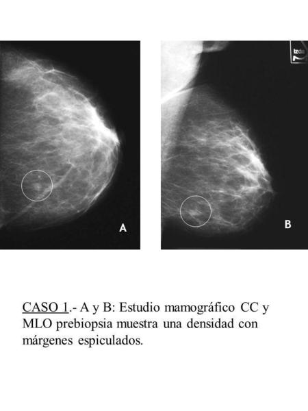 B A E CASO 1.- A y B: Estudio mamográfico CC y MLO prebiopsia muestra una densidad con márgenes espiculados. C D.
