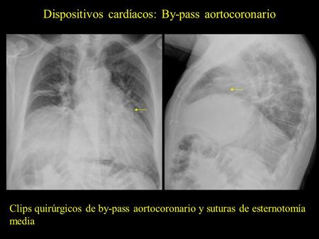 Dispositivos cardíacos: By-pass aortocoronario