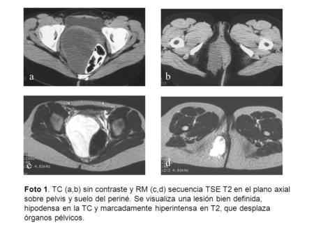 A b c d Foto 1. TC (a,b) sin contraste y RM (c,d) secuencia TSE T2 en el plano axial sobre pelvis y suelo del periné. Se visualiza una lesión bien definida,