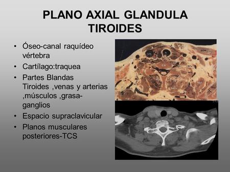 PLANO AXIAL GLANDULA TIROIDES