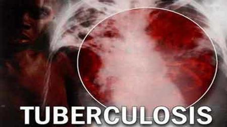 La tuberculosis Vía de Transmisión