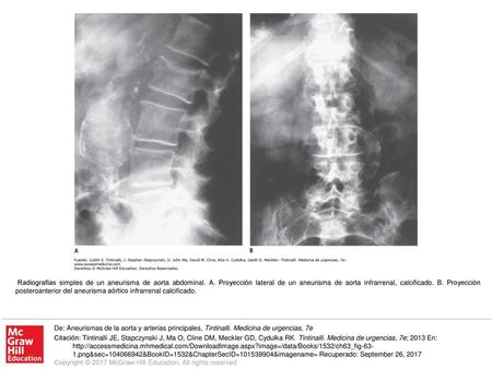 Radiografías simples de un aneurisma de aorta abdominal. A