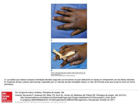 A. Los dedos que rodean el espacio interdigital afectado (segundo) se encuentran en gran abducción en reposo en comparación con los dedos restantes. B.
