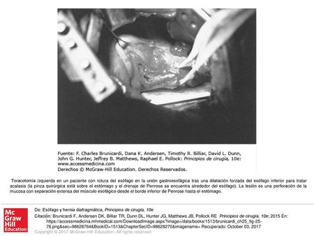 Toracotomía izquierda en un paciente con rotura del esófago en la unión gastroesofágica tras una dilatación forzada del esófago inferior para tratar acalasia.