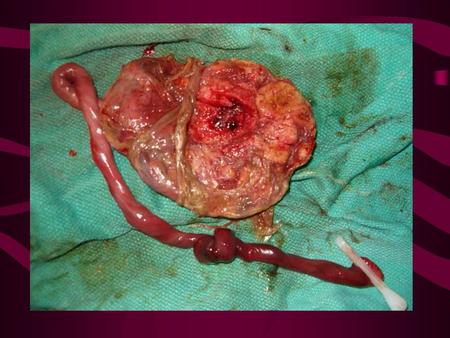 Placenta previa y desprendimiento