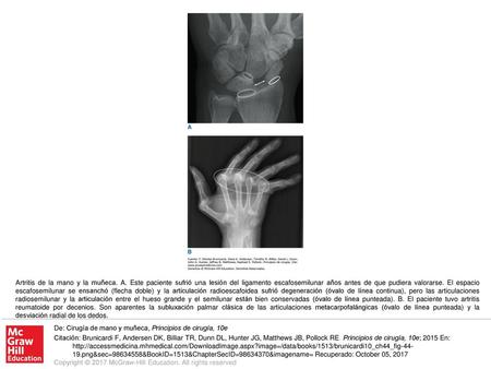 Artritis de la mano y la muñeca. A