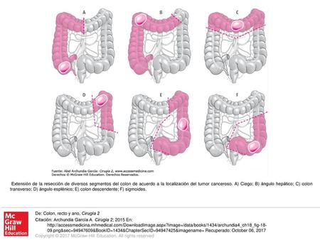 Extensión de la resección de diversos segmentos del colon de acuerdo a la localización del tumor canceroso. A) Ciego; B) ángulo hepático; C) colon transverso;