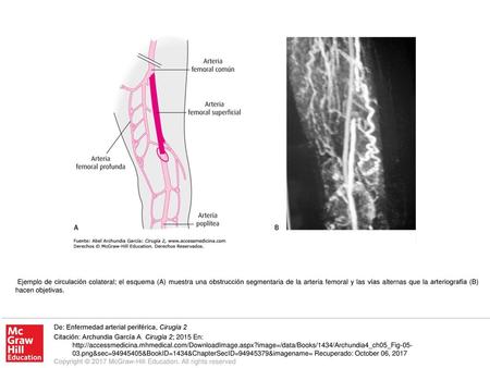 Ejemplo de circulación colateral; el esquema (A) muestra una obstrucción segmentaria de la arteria femoral y las vías alternas que la arteriografía (B)