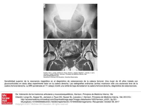 Sensibilidad superior de la resonancia magnética en el diagnóstico de osteonecrosis de la cabeza femoral. Una mujer de 45 años tratada con glucocorticoides.