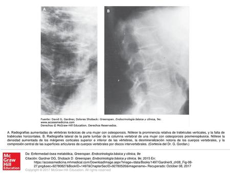 A. Radiografías aumentadas de vértebras torácicas de una mujer con osteoporosis. Nótese la prominencia relativa de trabéculas verticales, y la falta de.