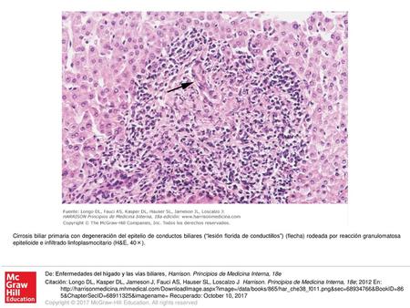 Cirrosis biliar primaria con degeneración del epitelio de conductos biliares (“lesión florida de conductillos”) (flecha) rodeada por reacción granulomatosa.
