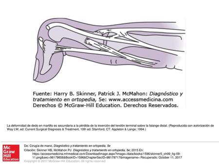 La deformidad de dedo en martillo es secundaria a la pérdida de la inserción del tendón terminal sobre la falange distal. (Reproducida con autorización.