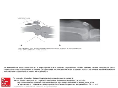La observación de una lipohemartrosis en la proyección lateral de la rodilla en un paciente en decúbito supino es un signo específico de fractura intraarticular.