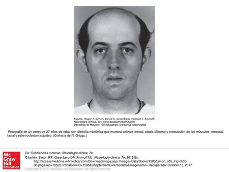 Fotografía de un varón de 37 años de edad con distrofia miotónica que muestra calvicie frontal, ptosis bilateral y emaciación de los músculos temporal,