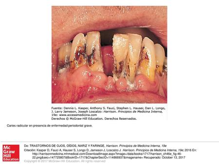 Caries radicular en presencia de enfermedad periodontal grave.