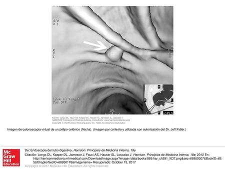 Imagen de colonoscopia virtual de un pólipo colónico (flecha)