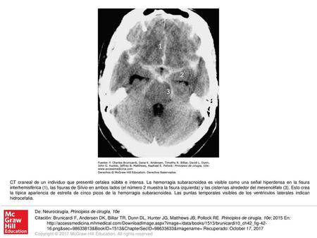 CT craneal de un individuo que presentó cefalea súbita e intensa