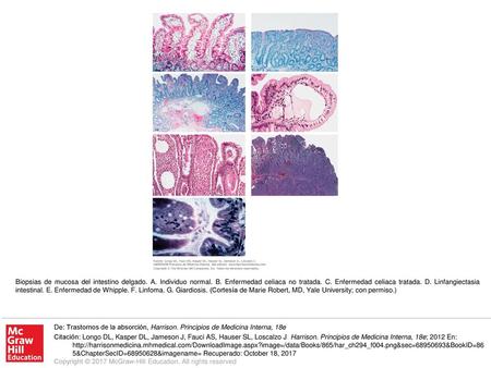 Biopsias de mucosa del intestino delgado. A. Individuo normal. B