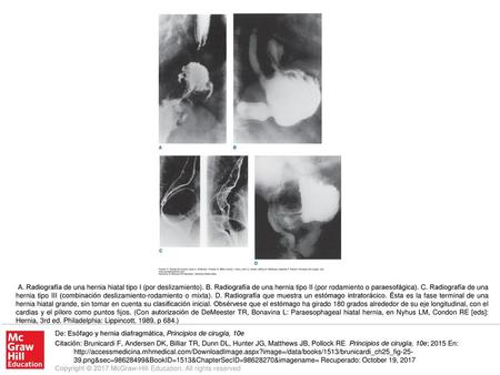 A. Radiografía de una hernia hiatal tipo I (por deslizamiento). B
