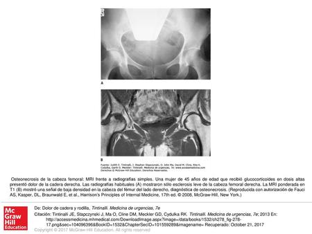 Osteonecrosis de la cabeza femoral: MRI frente a radiografías simples