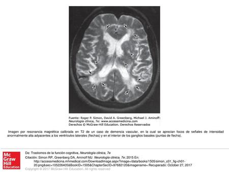 Imagen por resonancia magnética calibrada en T2 de un caso de demencia vascular, en la cual se aprecian focos de señales de intensidad anormalmente alta.