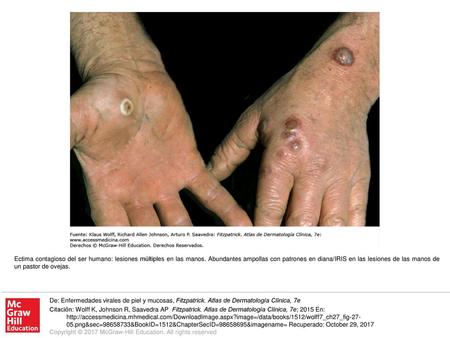 Ectima contagioso del ser humano: lesiones múltiples en las manos