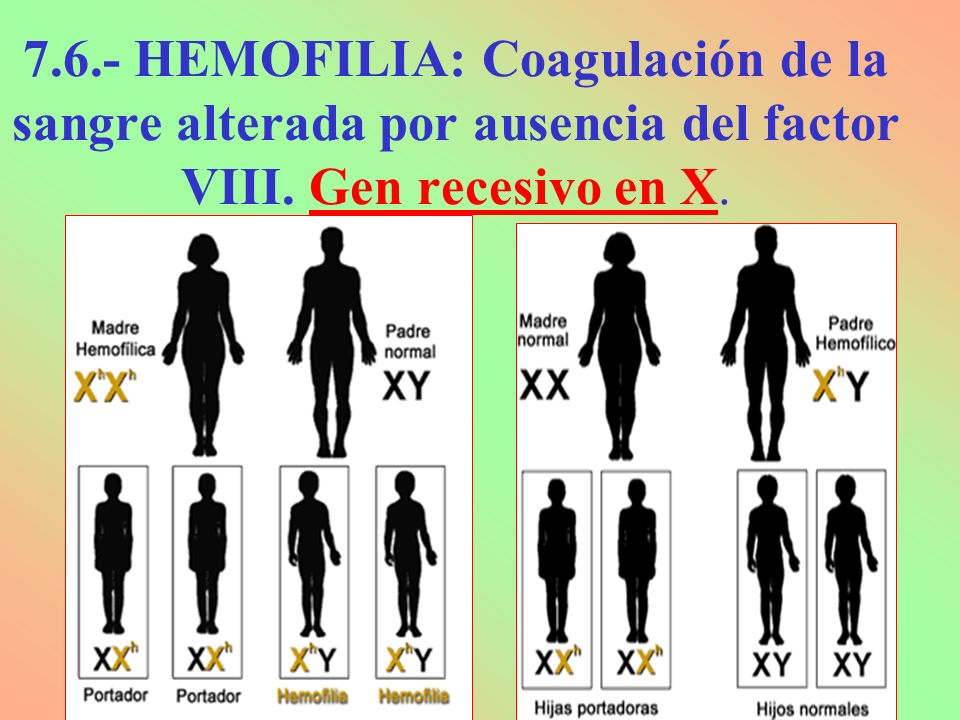 7.6.- HEMOFILIA: Coagulación de la sangre alterada por ausencia del factor VIII. Gen recesivo en X.