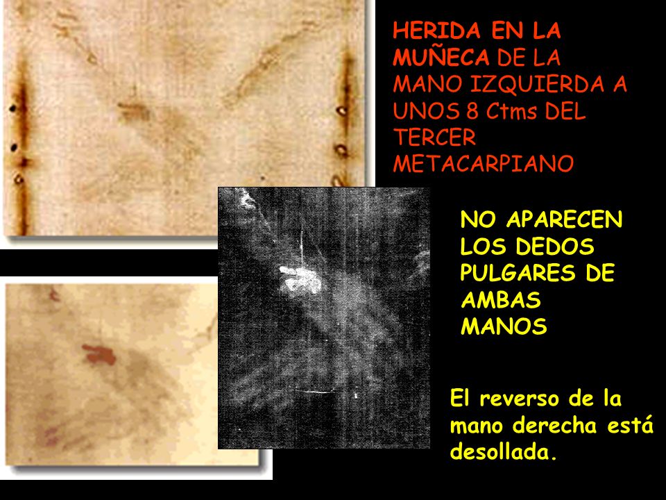 HERIDA EN LA MUÑECA DE LA MANO IZQUIERDA A UNOS 8 Ctms DEL TERCER METACARPIANO.