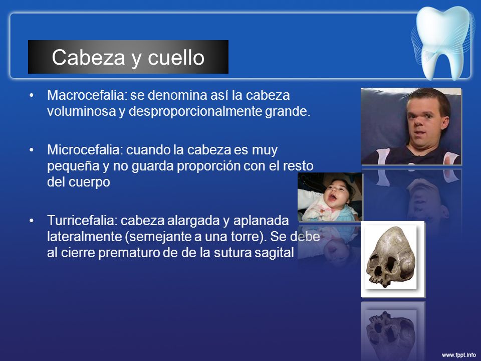 Cabeza y cuello Macrocefalia: se denomina así la cabeza voluminosa y desproporcionalmente grande.