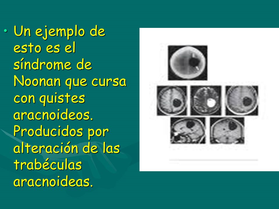 Un ejemplo de esto es el síndrome de Noonan que cursa con quistes aracnoideos.