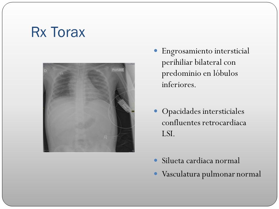 Rx Torax Engrosamiento intersticial perihiliar bilateral con predominio en lóbulos inferiores.