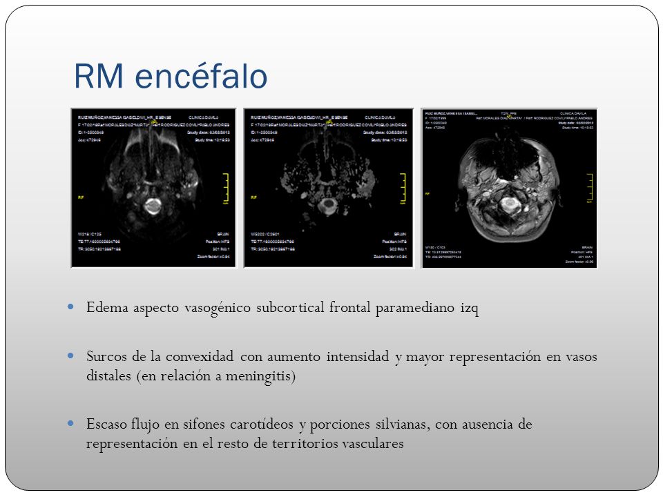 RM encéfalo Edema aspecto vasogénico subcortical frontal paramediano izq.