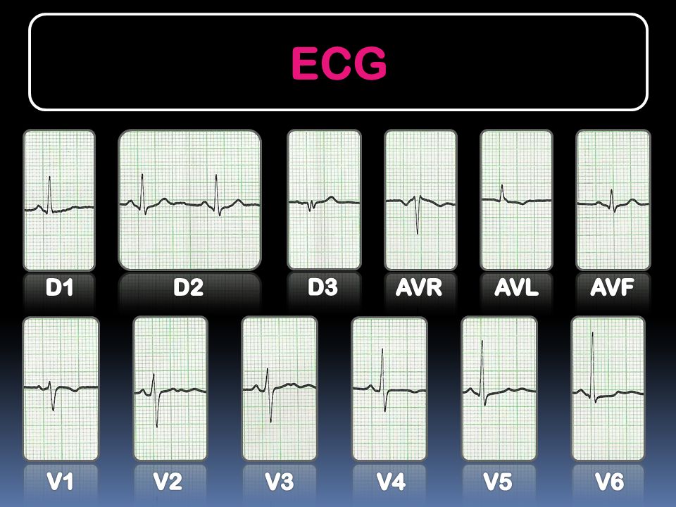 ECG D1 D2 D3 AVR AVL AVF V1 V2 V3 V4 V5 V6