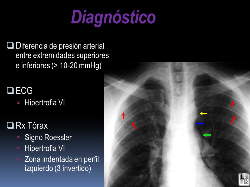 Diagnóstico Diferencia de presión arterial entre extremidades superiores e inferiores (> mmHg)