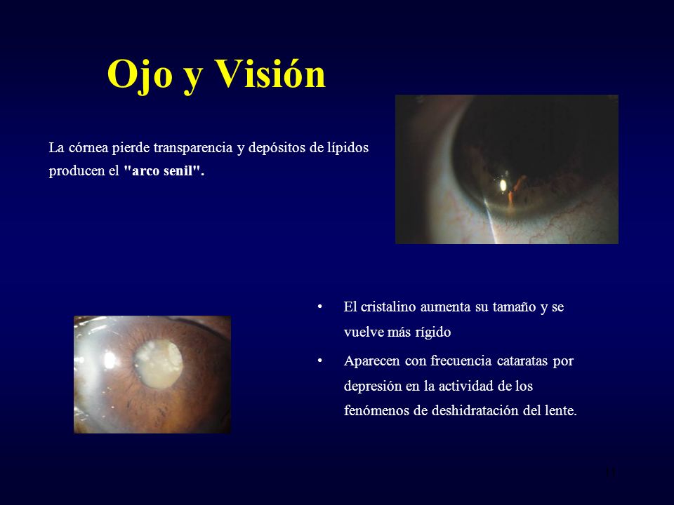 Ojo y Visión La córnea pierde transparencia y depósitos de lípidos producen el arco senil . El cristalino aumenta su tamaño y se vuelve más rígido.
