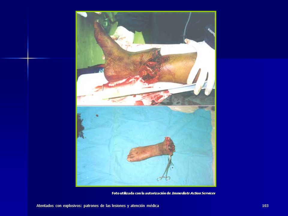 Atentados con explosivos: patrones de las lesiones y atención médica