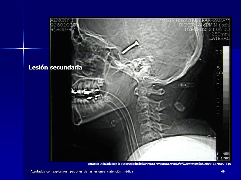 Lesión secundaria Imagen utilizada con la autorización de la revista American Journal of Roentgenology 2006; 187: