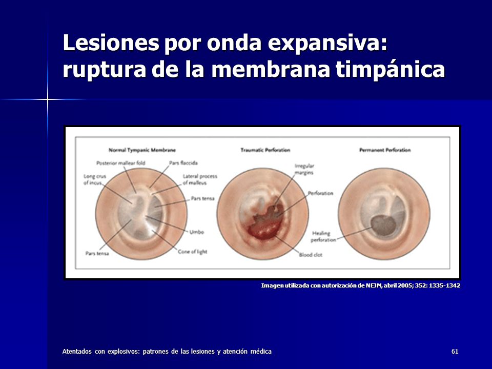 Lesiones por onda expansiva: ruptura de la membrana timpánica