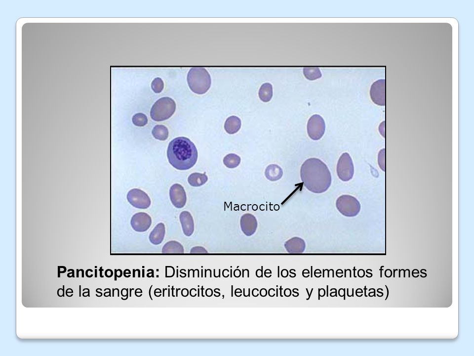 Macrocito Pancitopenia: Disminución de los elementos formes de la sangre (eritrocitos, leucocitos y plaquetas)