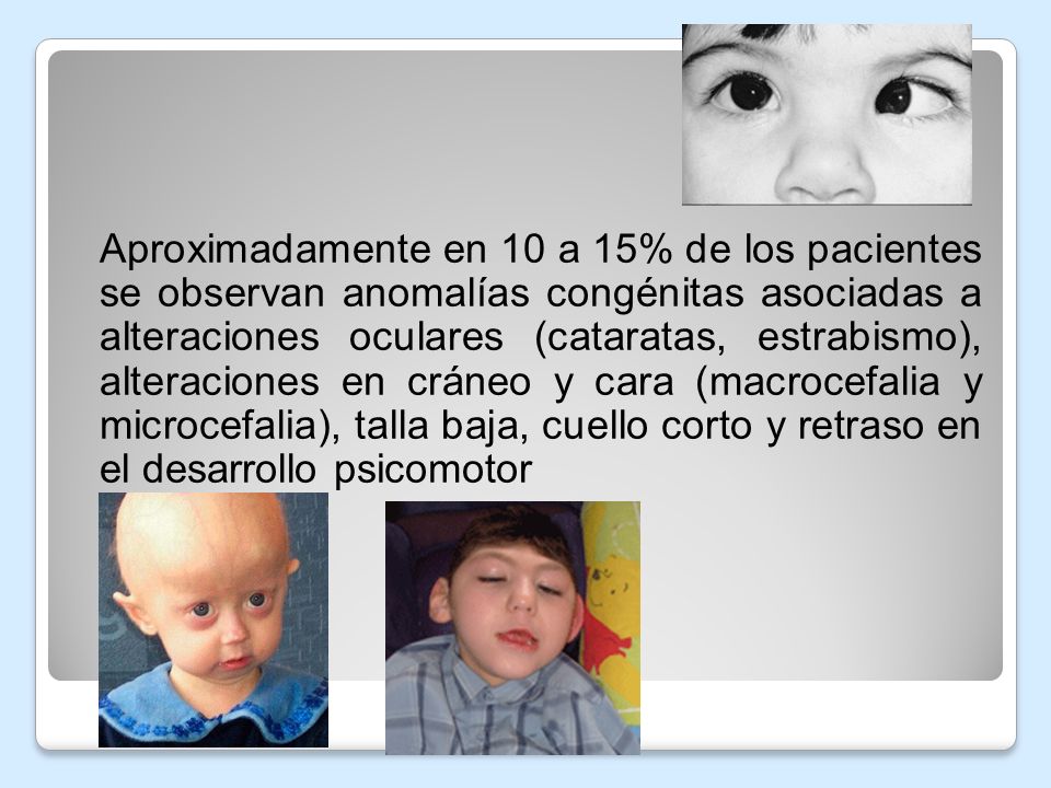Aproximadamente en 10 a 15% de los pacientes se observan anomalías congénitas asociadas a alteraciones oculares (cataratas, estrabismo), alteraciones en cráneo y cara (macrocefalia y microcefalia), talla baja, cuello corto y retraso en el desarrollo psicomotor