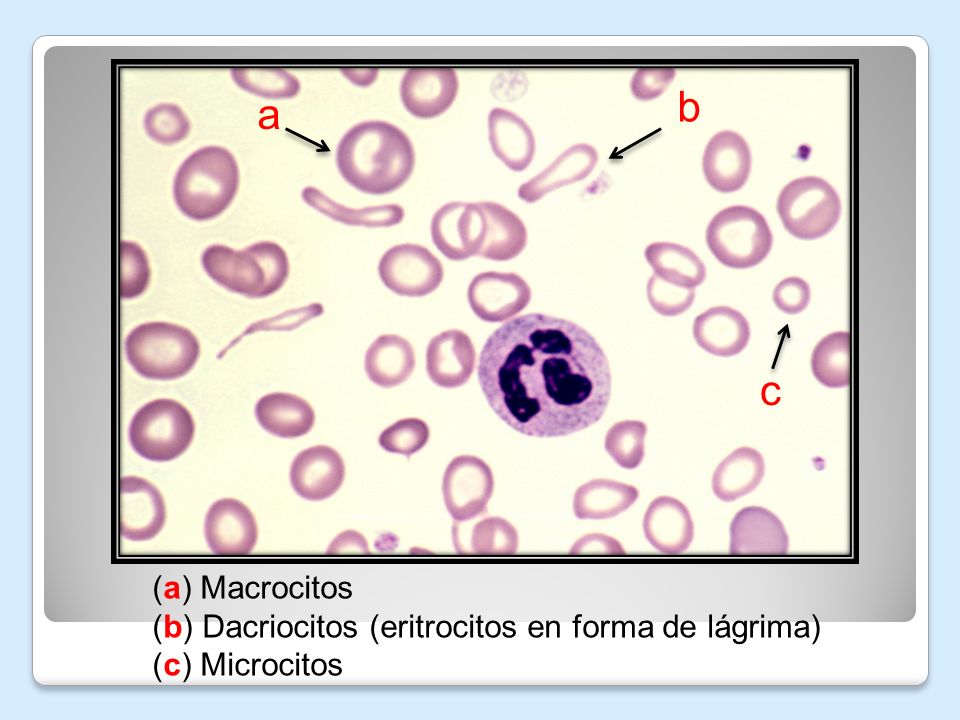 b a c (a) Macrocitos (b) Dacriocitos (eritrocitos en forma de lágrima)